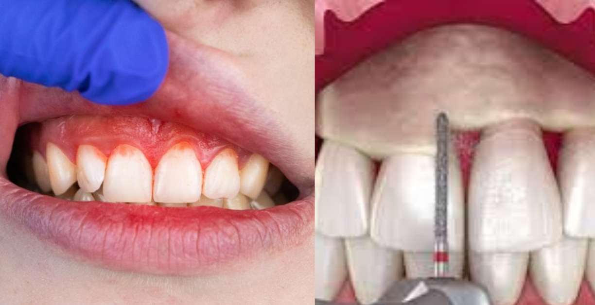 how long do cut gums take to heal