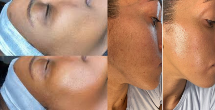 dermaplaning before and after on dark skin