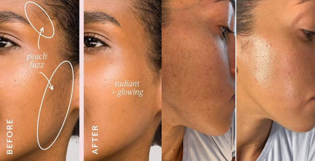 dermaplaning before and after on dark skin