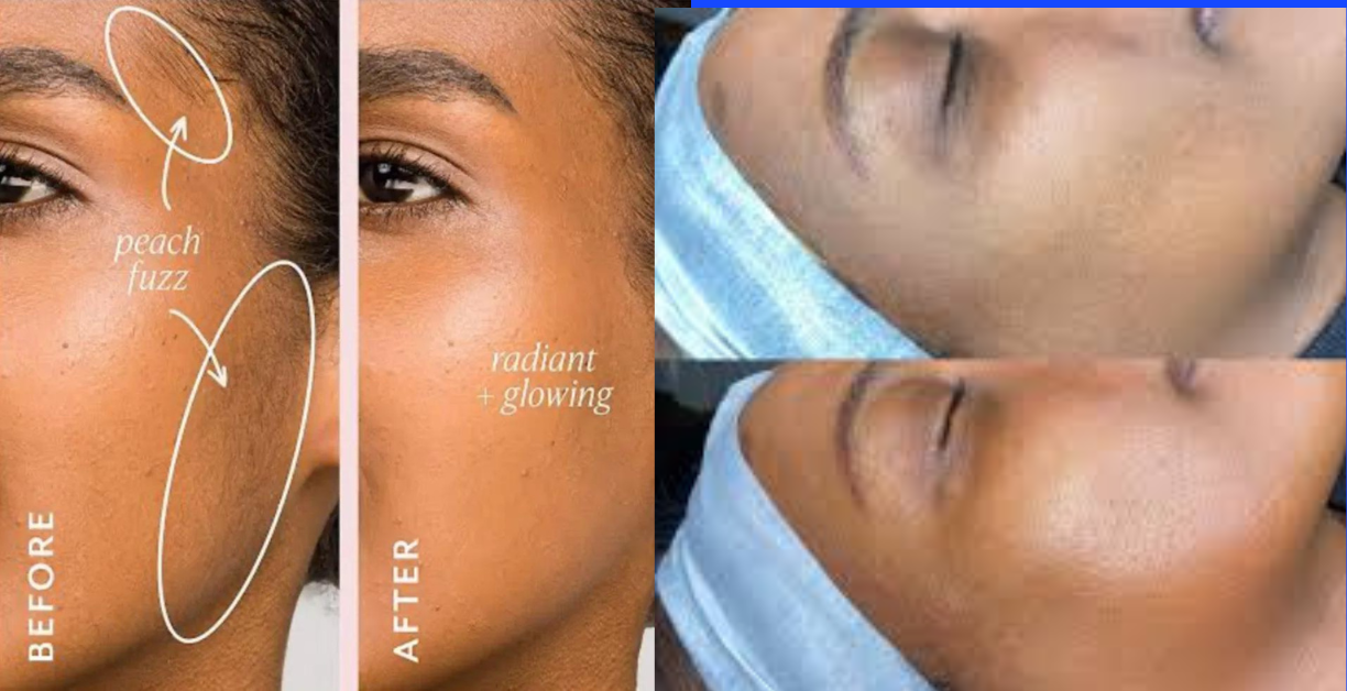 dermaplaning before and after on dark skin